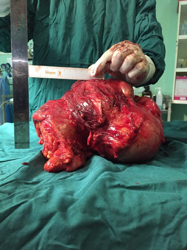 خارج کردن تومور 8 کیلویی از پای جوان مازندرانی