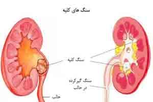 علائم وجود سنگ کلیه