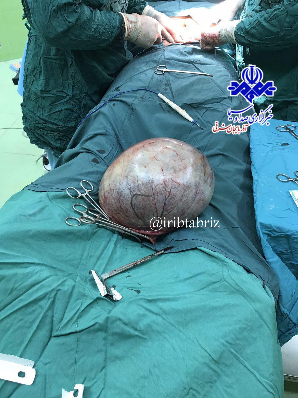 خارج کردن توده 8 کیلویی از شکم بیماری چاراویماق خارج کردن توده 8 کیلویی از شکم بیماری چاراویماق