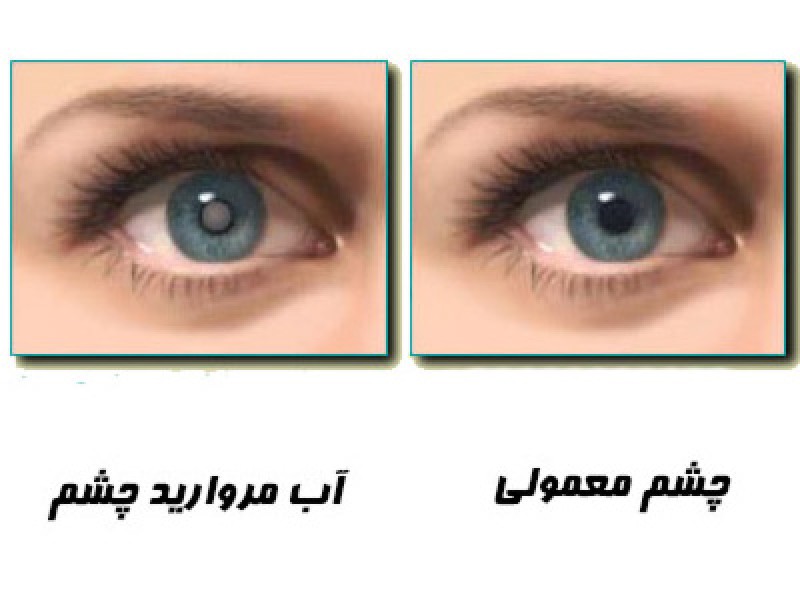 چرا باید از عینک آفتابی استفاده کنیم؟