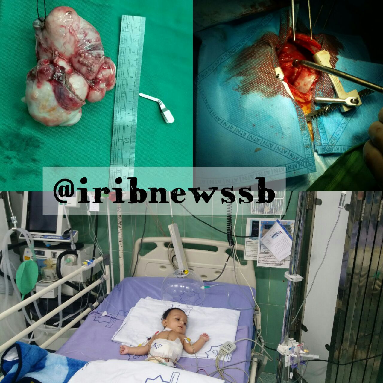 خارج کردن تومور 12 سانتیمتری از قلب نوزاد سه ماهه در زاهدان