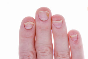 ارتباط شکل ظاهری ناخن&zwnj;ها با سلامتی