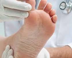 درمان جامع زخم پای دیابتی در مرکز دیابت یزد