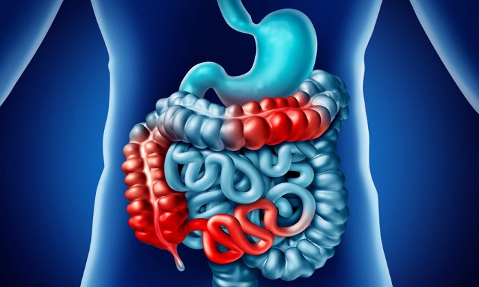 نحوه مقابله با بيماري کرون نحوه مقابله با بيماري کرون