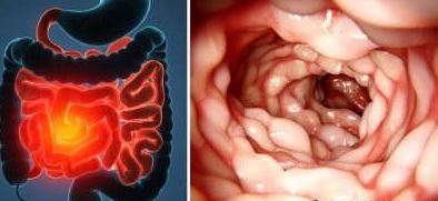 نحوه مقابله با بيماري کرون نحوه مقابله با بيماري کرون