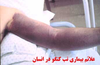 تب کنگو چگونه منتقل می شود؟