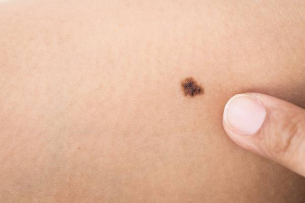 سرطانی که همه جای پوست را میگیرد!