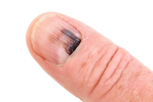 سرطانی که همه جای پوست را میگیرد!