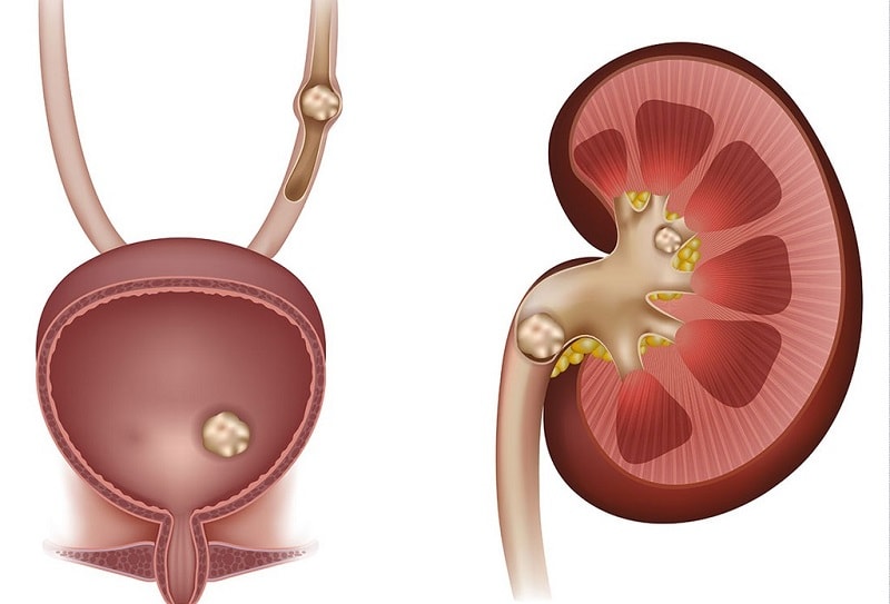 نوشیدنی ماءالشعیر سنگ‌ کلیه می‌سازد!