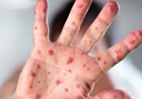 شیوع سرخک در آمریکا به بالاترین سطح در ۲۵ سال اخیر رسید