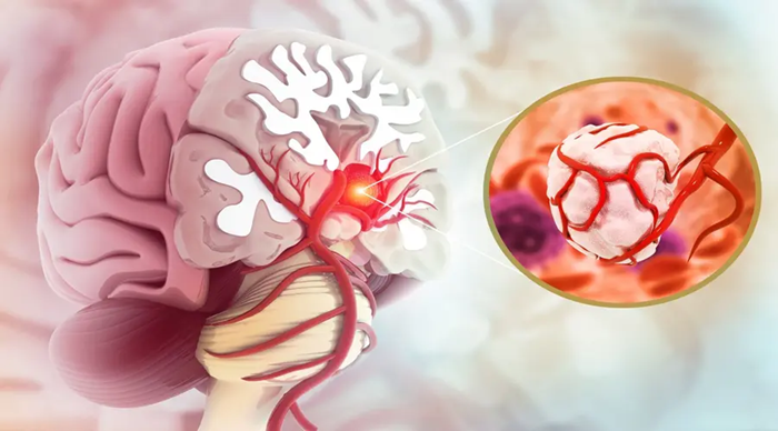 تشخیص زودهنگام، ناجی بیماران مبتلا به تومور‌های مغزی و نخاعی