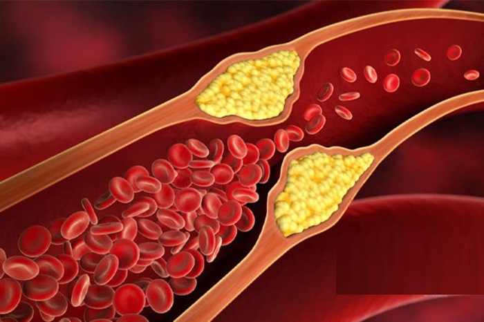 راهکار‌های افزایش اثربخشی دارو‌های کاهنده چربی خون