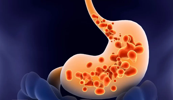 آنچه باید درباره رفلاکس معده بدانیم