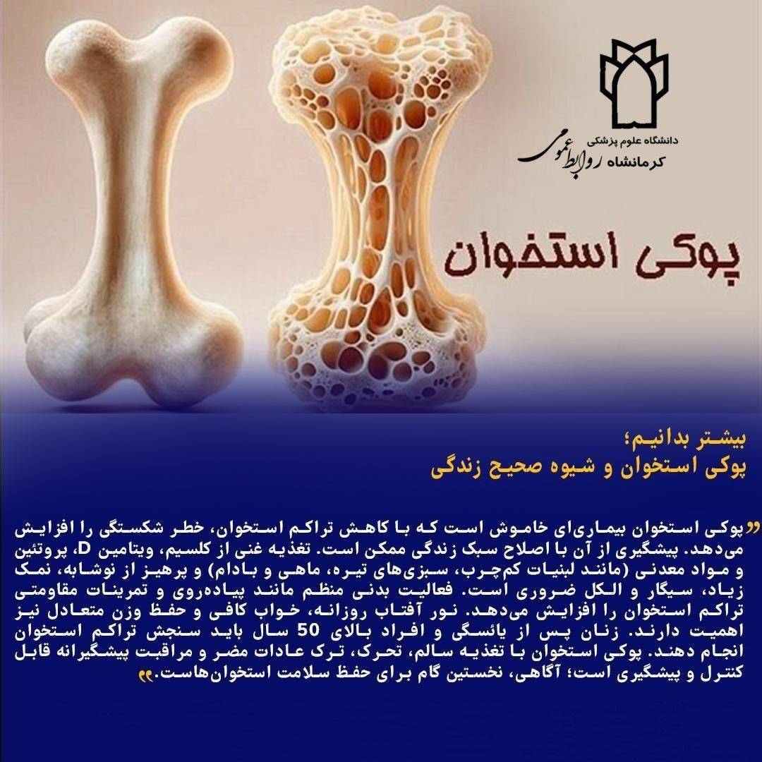 بیماری پوکی استخوان را بیشتر بشناسیم